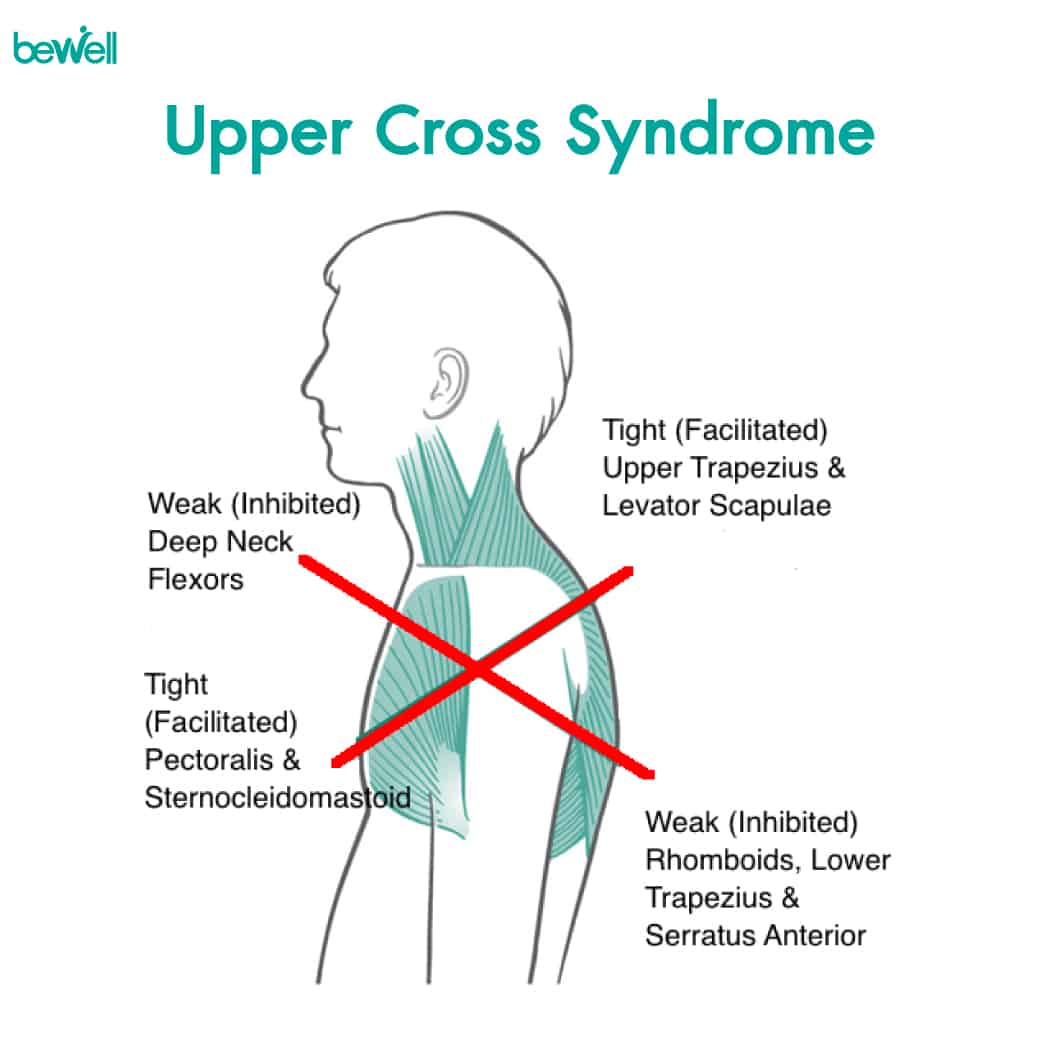 Upper Cross Syndrome โรคของคนหลังค่อม Bewell